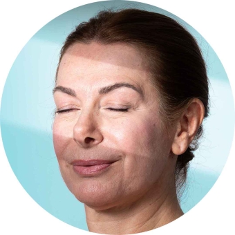 Microneedling viso e collo