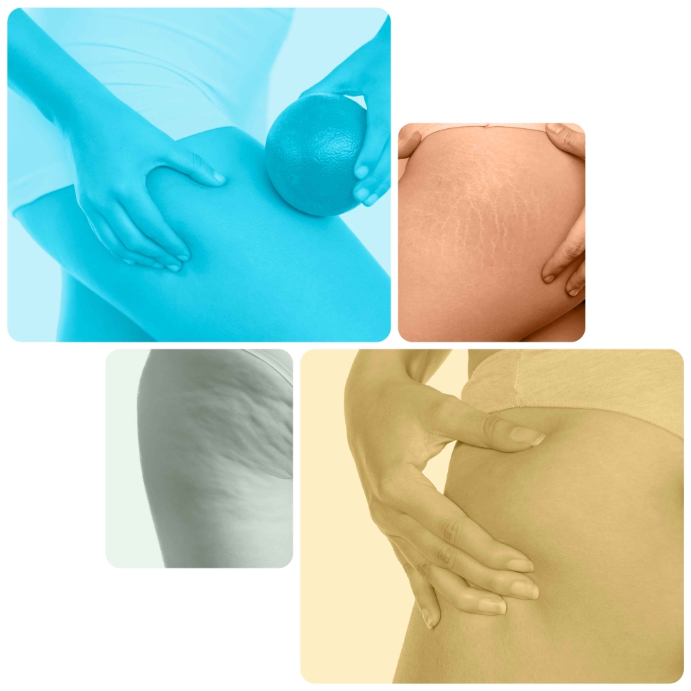 Mesoterapia corpo